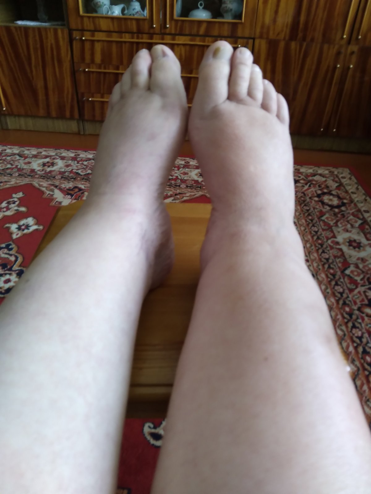 Ноги пацієнтки під час лікування