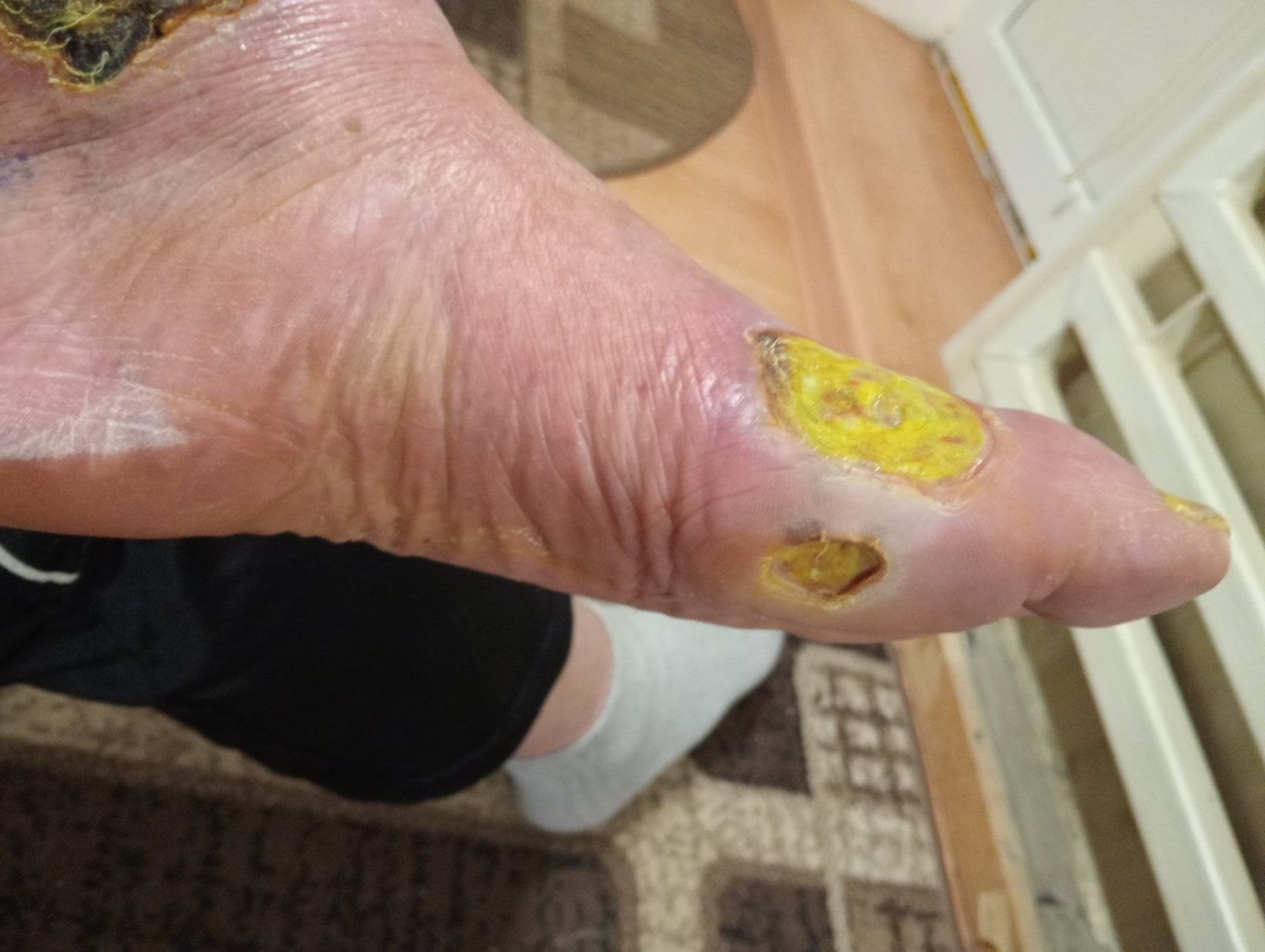 Діабетична стопа