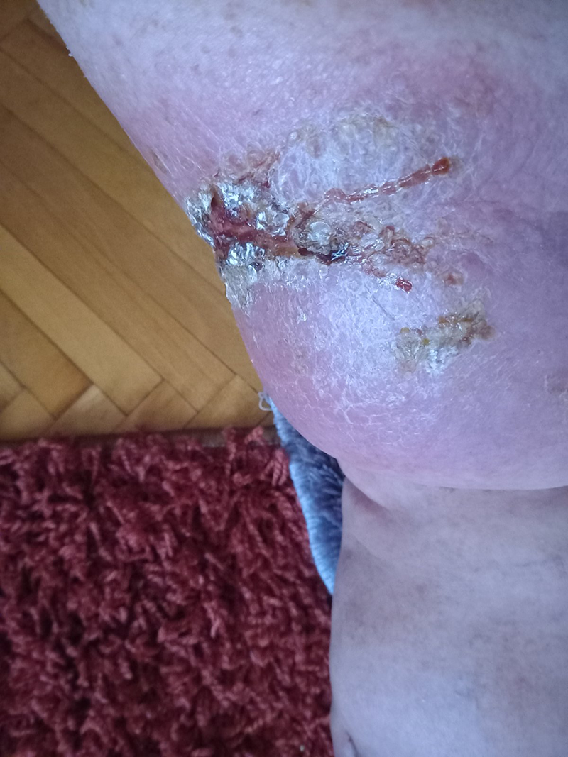 Початок ускладнень при набряках